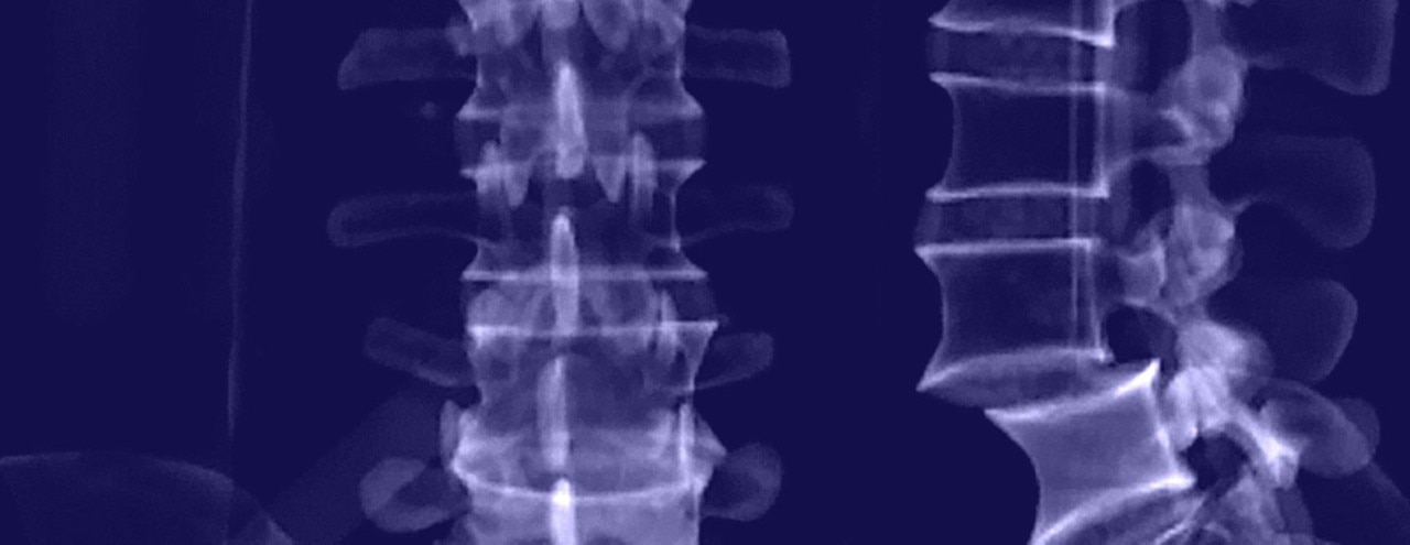 An x-ray of a human spine, showing two positions.