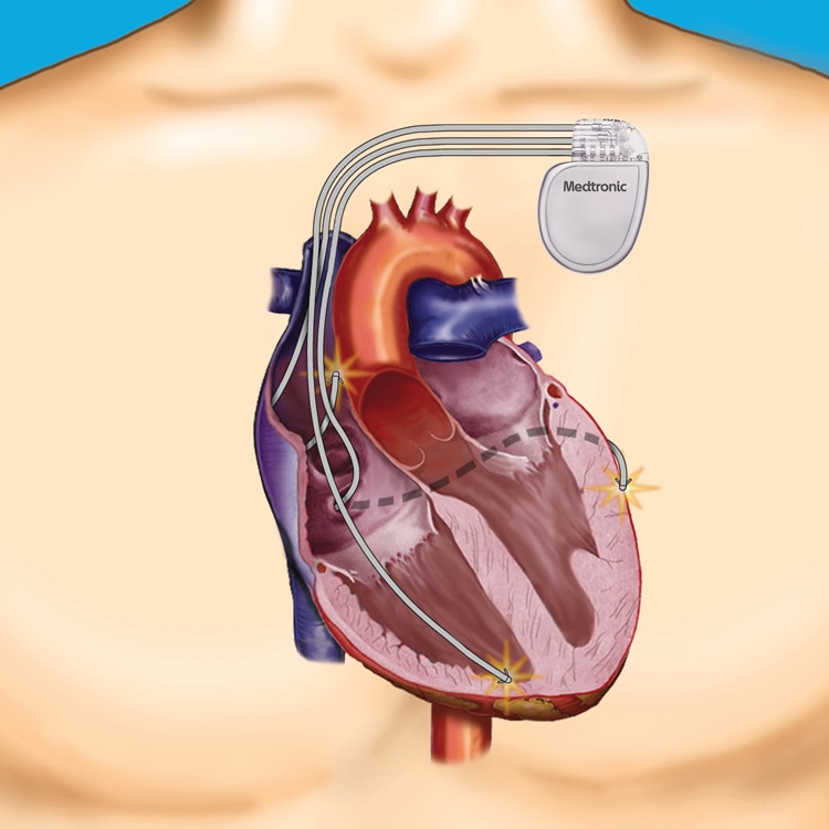 Image of ICD in heart