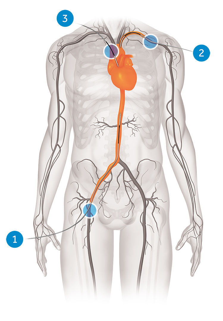 TAVR Incision Locations
