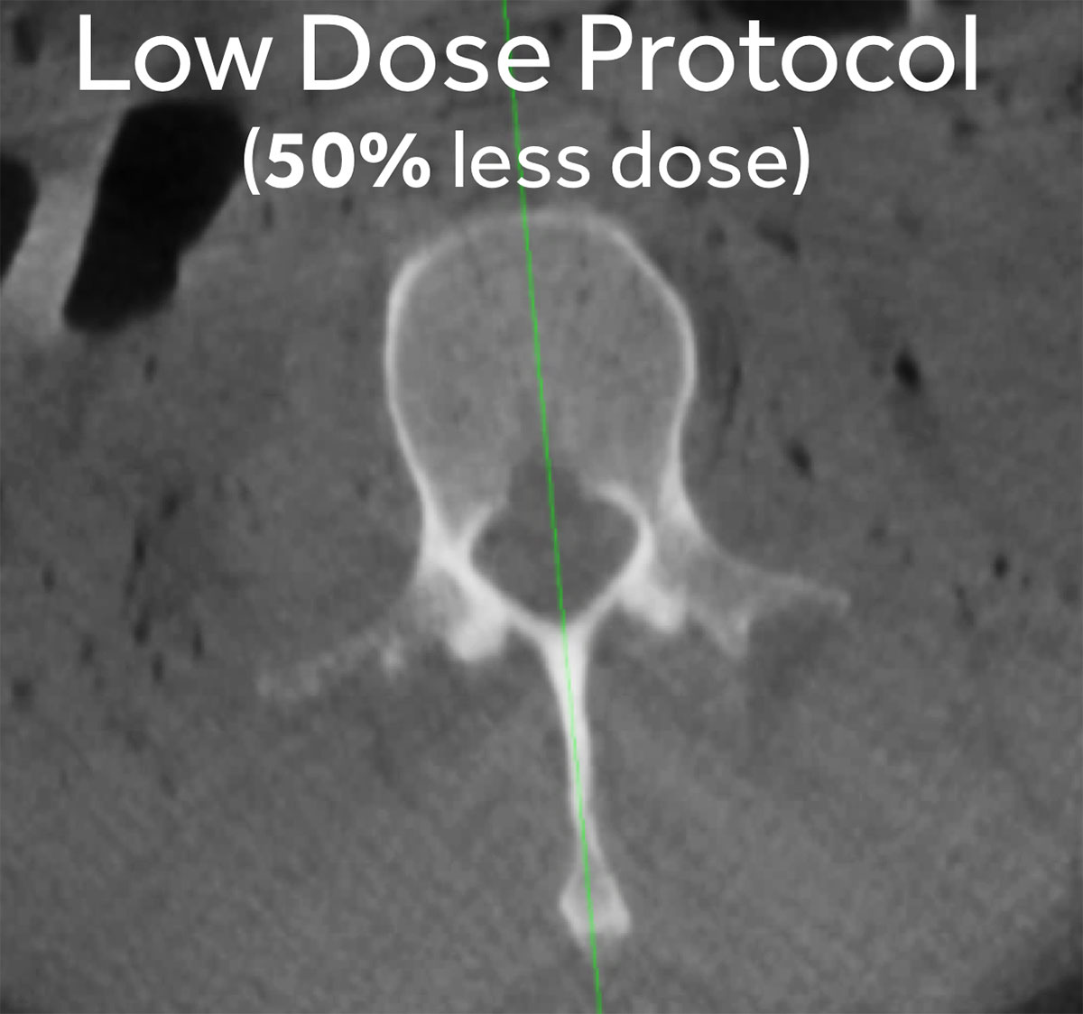 O-arm system low dose protocol (50% less dose)