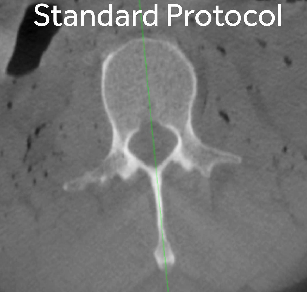 O-arm system standard dose protocol