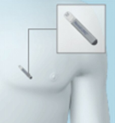 Image showing the positioning of Reveal LINQ in the chest