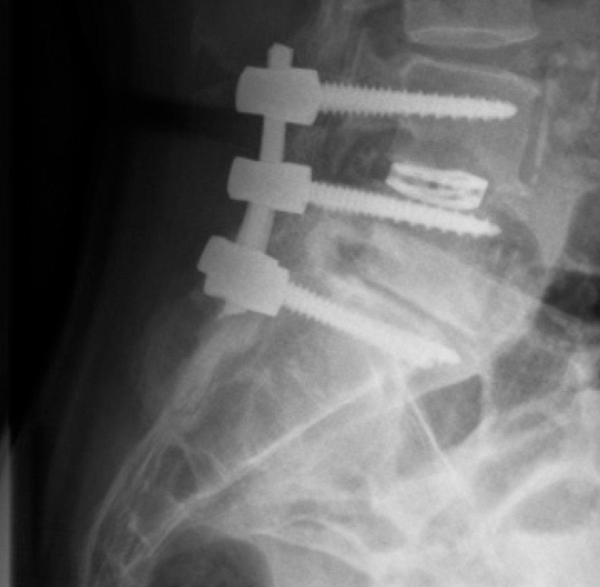 Mastergraft matrix strip