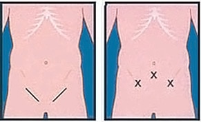 Open vs. laparoscopic repair