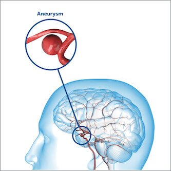 brain aneurysm