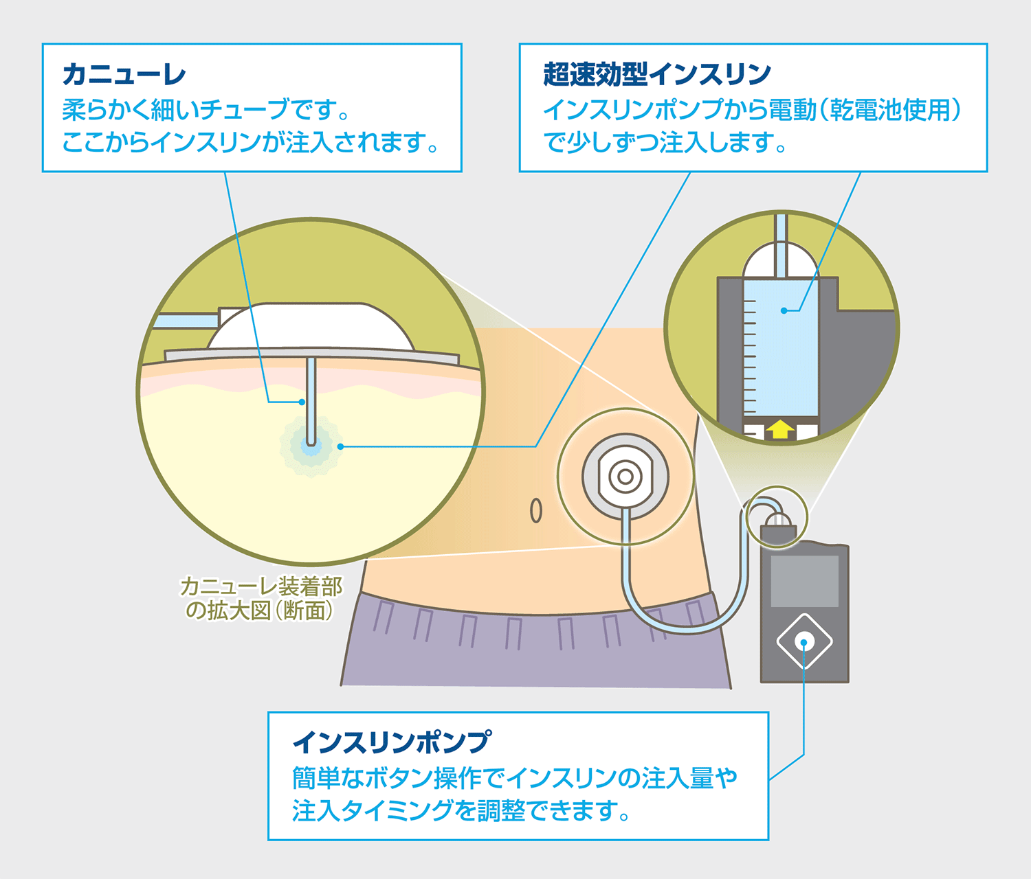 間歇 注入 シリンジ ポンプ と は