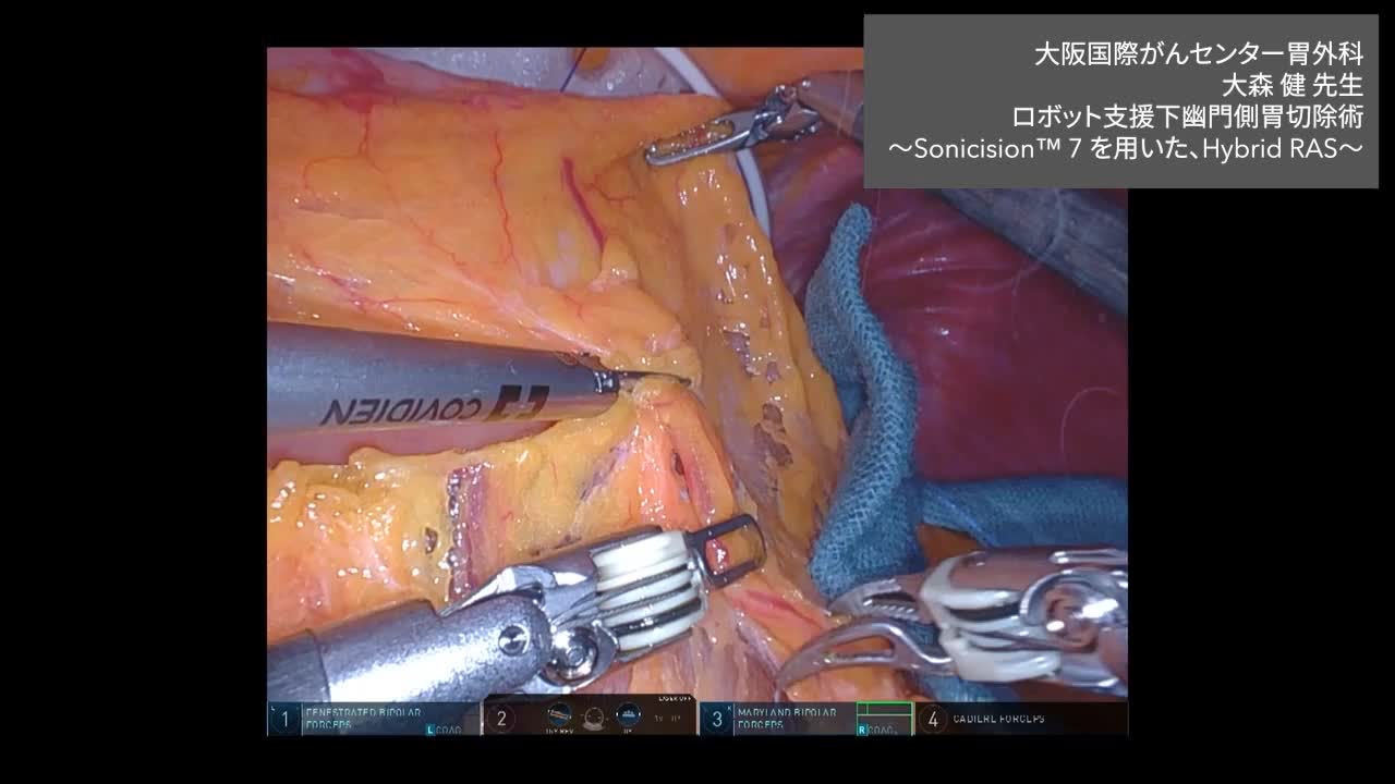 大阪国際がんセンター 胃外科 大森 健 先生 Sonicision™ 7 使用動画