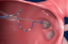 Illustrated animation of a pulsed field ablation (PFA) catheter ablating cardiac tissue in the pulmonary vein