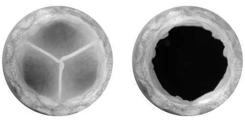 This is an image of the Harmony™ transcatheter pulmonary valve (TPV) leaflets.