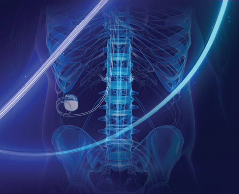 See a full body Inceptiv™ neurostimulator MRI image.