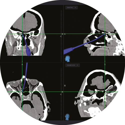 Head scan of Midas Rex MR8.
