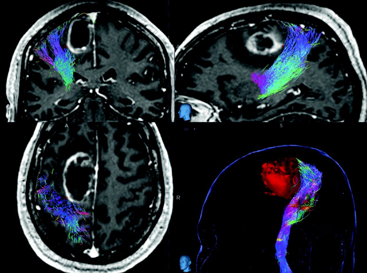 Visualization of brain fibers with CSD imaging