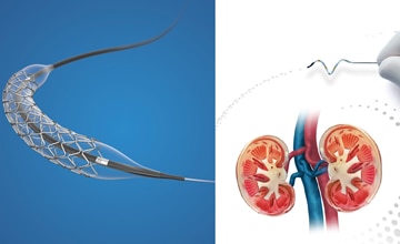 Onyx frontiertm is a drug-eluting stent (des) created to deliver a drug-eluting stent (des) specifically designed for challenging percutaneous coronary operations (pci).