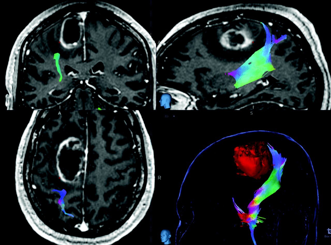 Visualization of brain fibers with DTI imaging