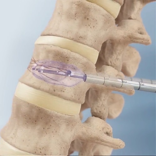 Kyphon™ balloon kyphoplasty involves inflating a balloon into the compressed vertebra to relieve pain.